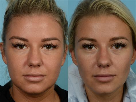 buccal fat removal 10 years later|The Long